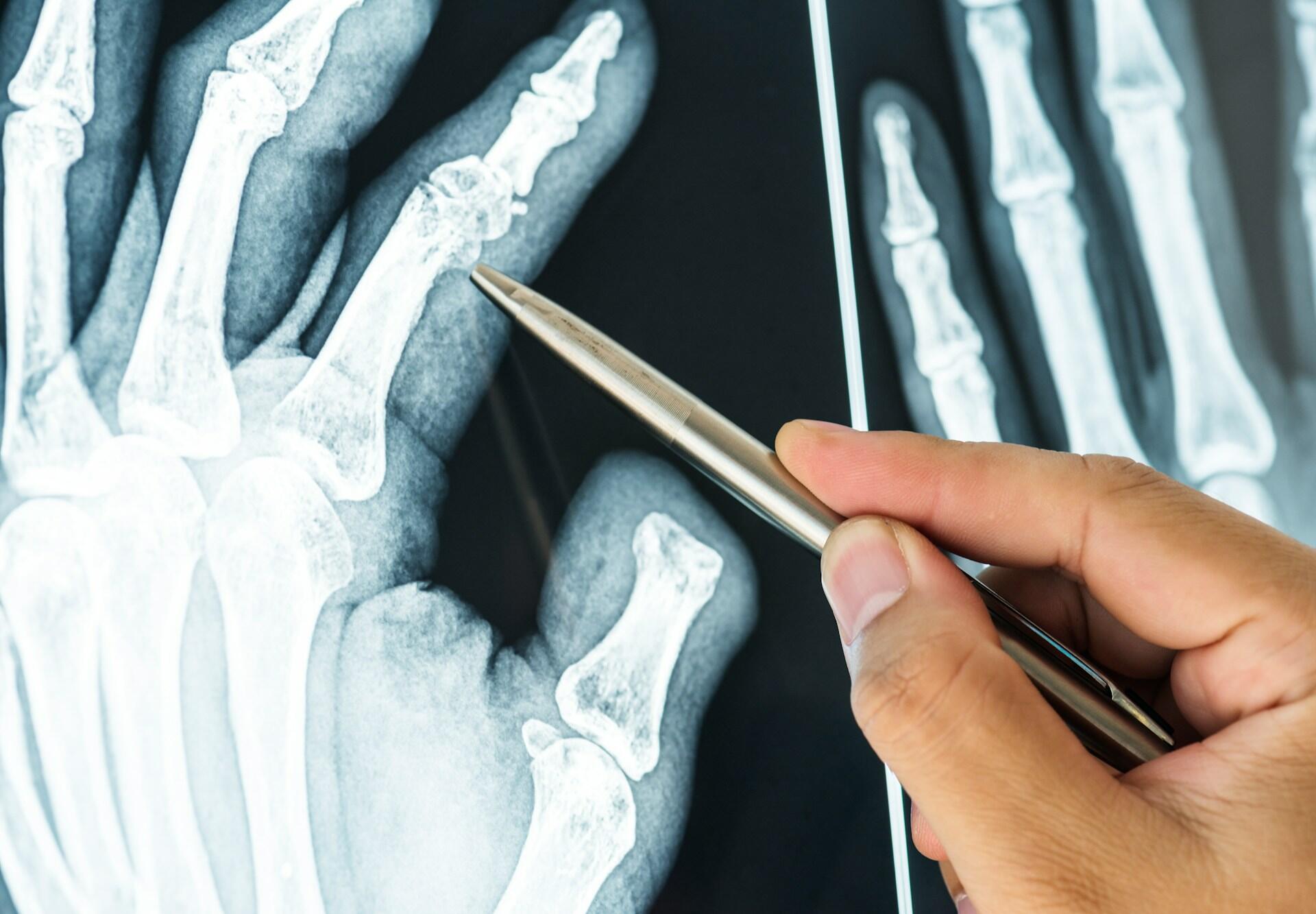 Radiografia de mãos.