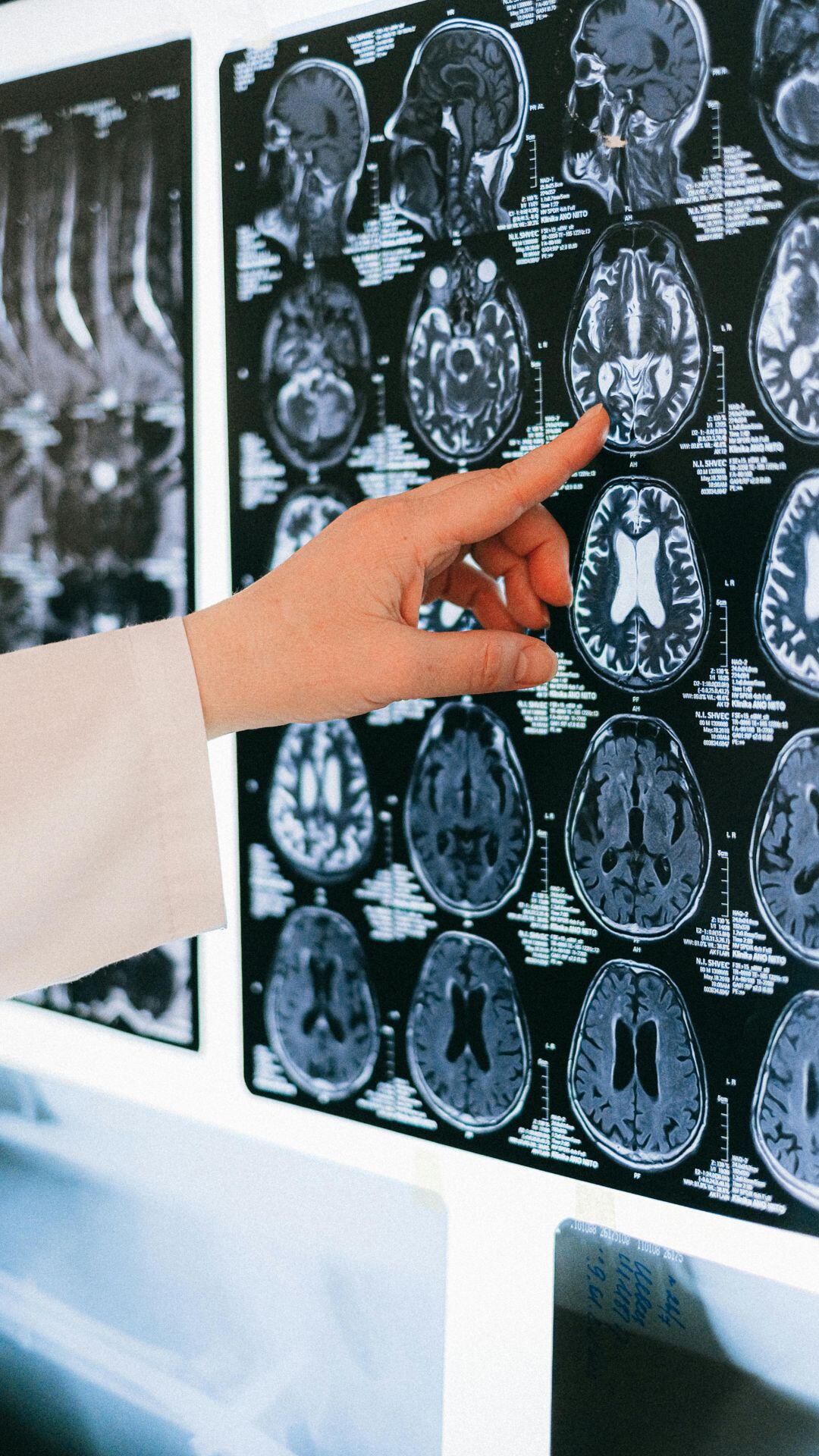 Doctor pointing at brain scans on a light board.