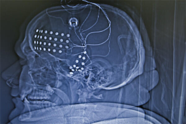 X-ray scan of a human skull showing implanted electrodes in the brain – neurosurgery procedure and neurological treatment.