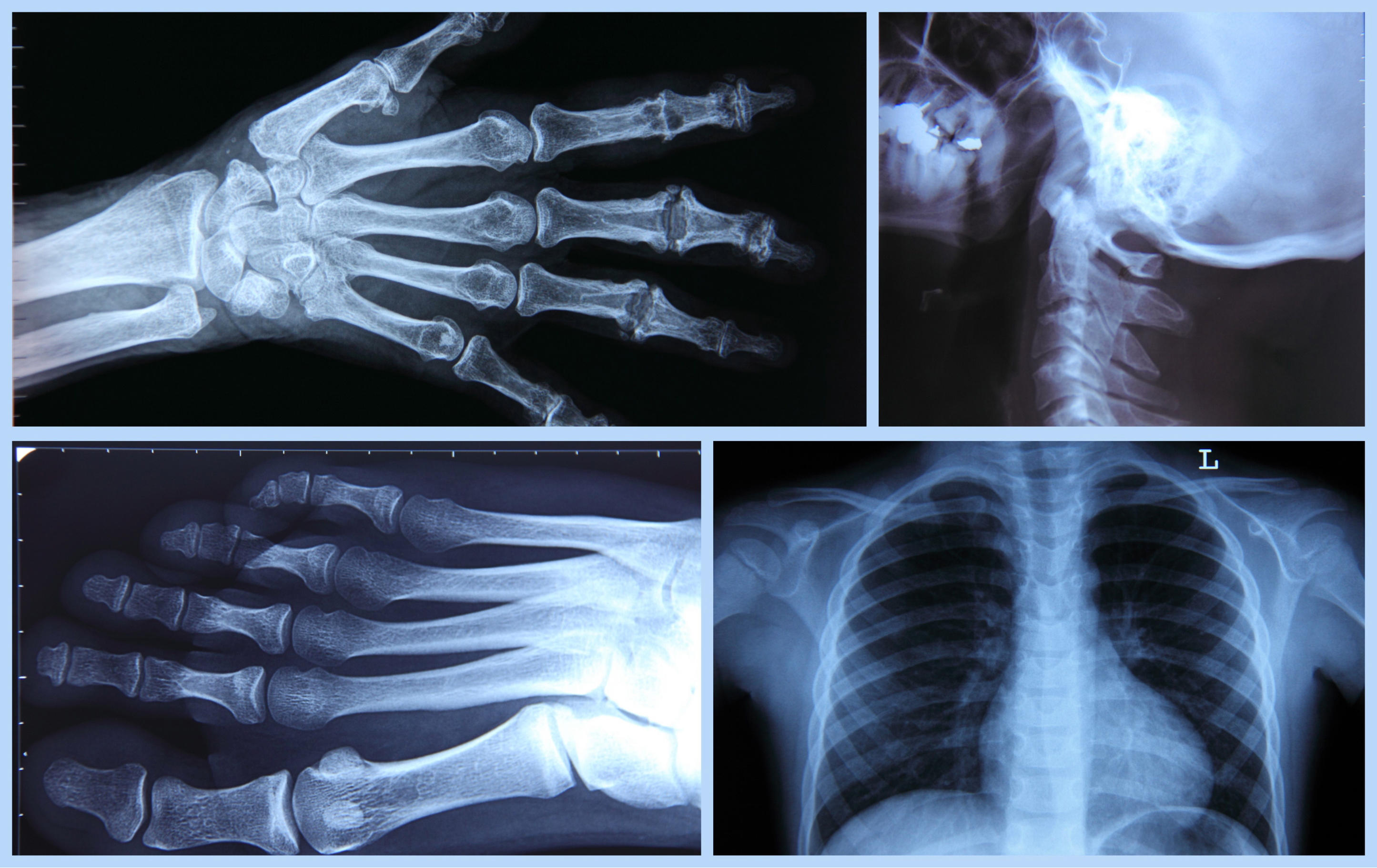 Direction l’imagerie médicale pour faire un état des lieux et déterminer la ou les fractures par le biais d’une radiographie élaborée à partir des mathématiques ou du scanner fondé sur le calcul intégral. 
