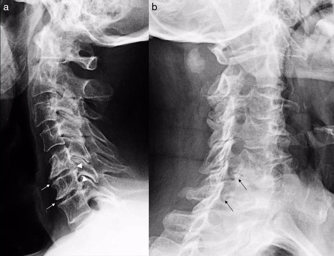 evita los dolores cervicales haciendo ejercicio