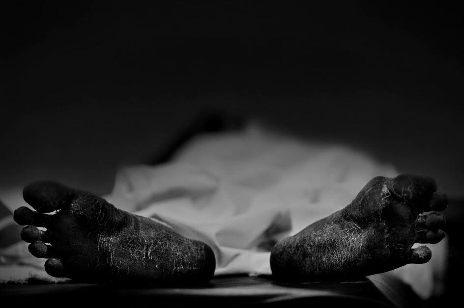 Imagen en blanco y negro de dos pies agrietados y secos que sobresalen de debajo de una sábana. El tono sombrío sugiere un cuerpo sin vida en una morgue.