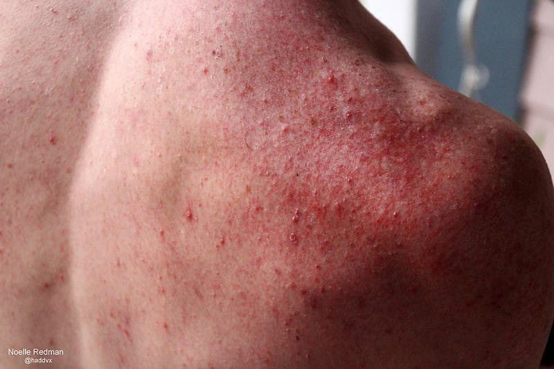 Pimples on the skin