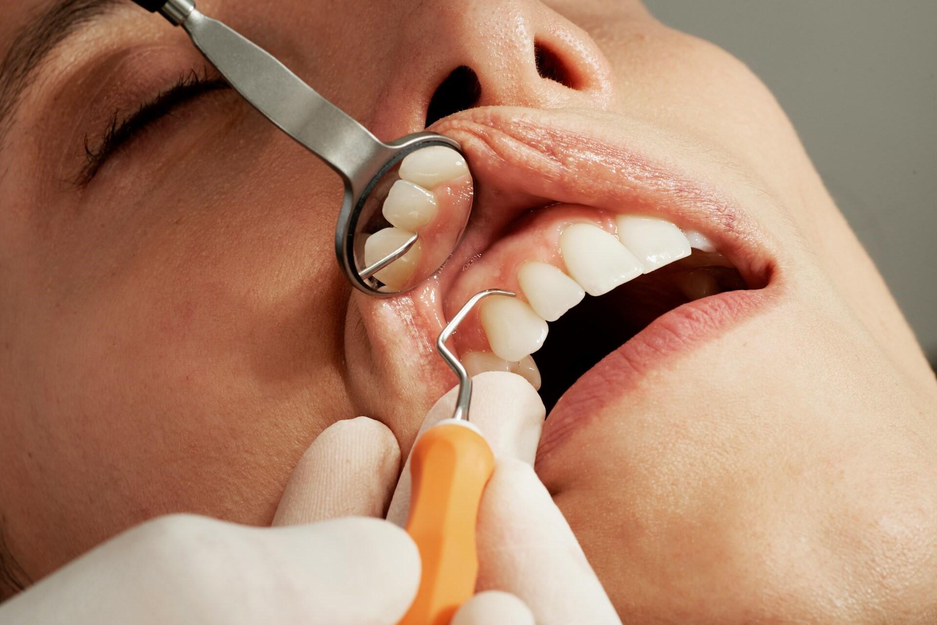 Close-up of dental tools examining a patient’s teeth