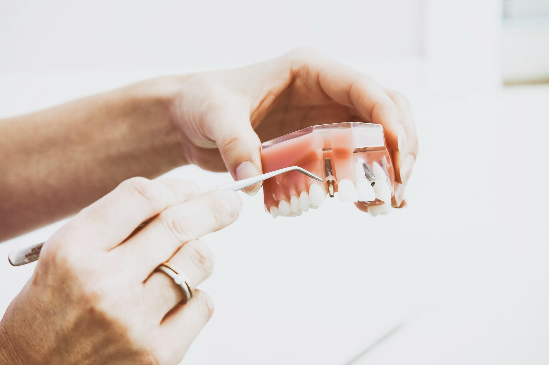 Hands holding a dental model with implants and a metal dental tool
