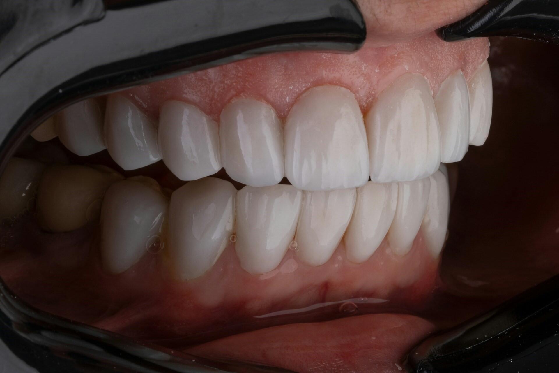Close-up of a patient’s teeth held open with dental retractors