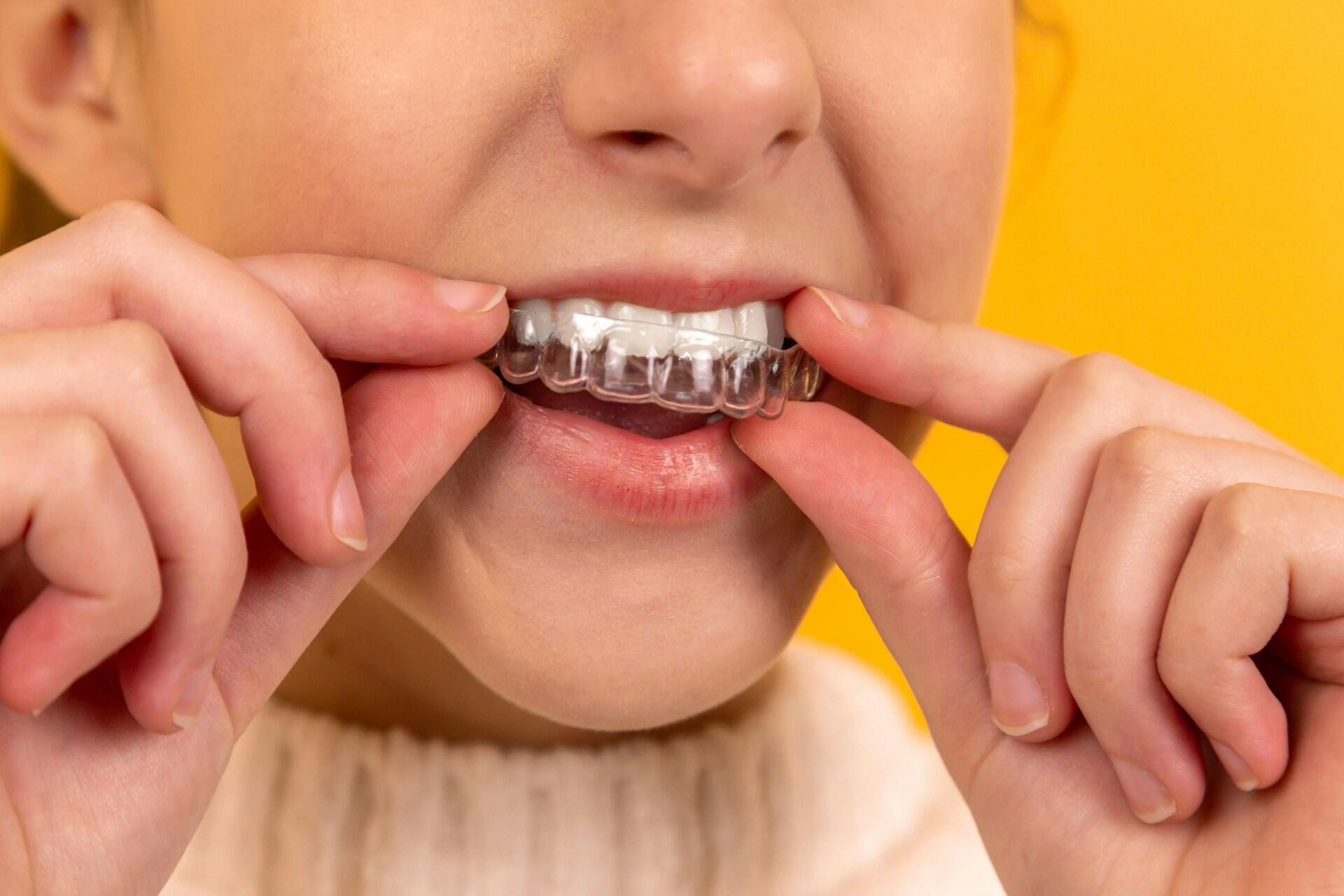 Person fitting a clear aligner over their teeth