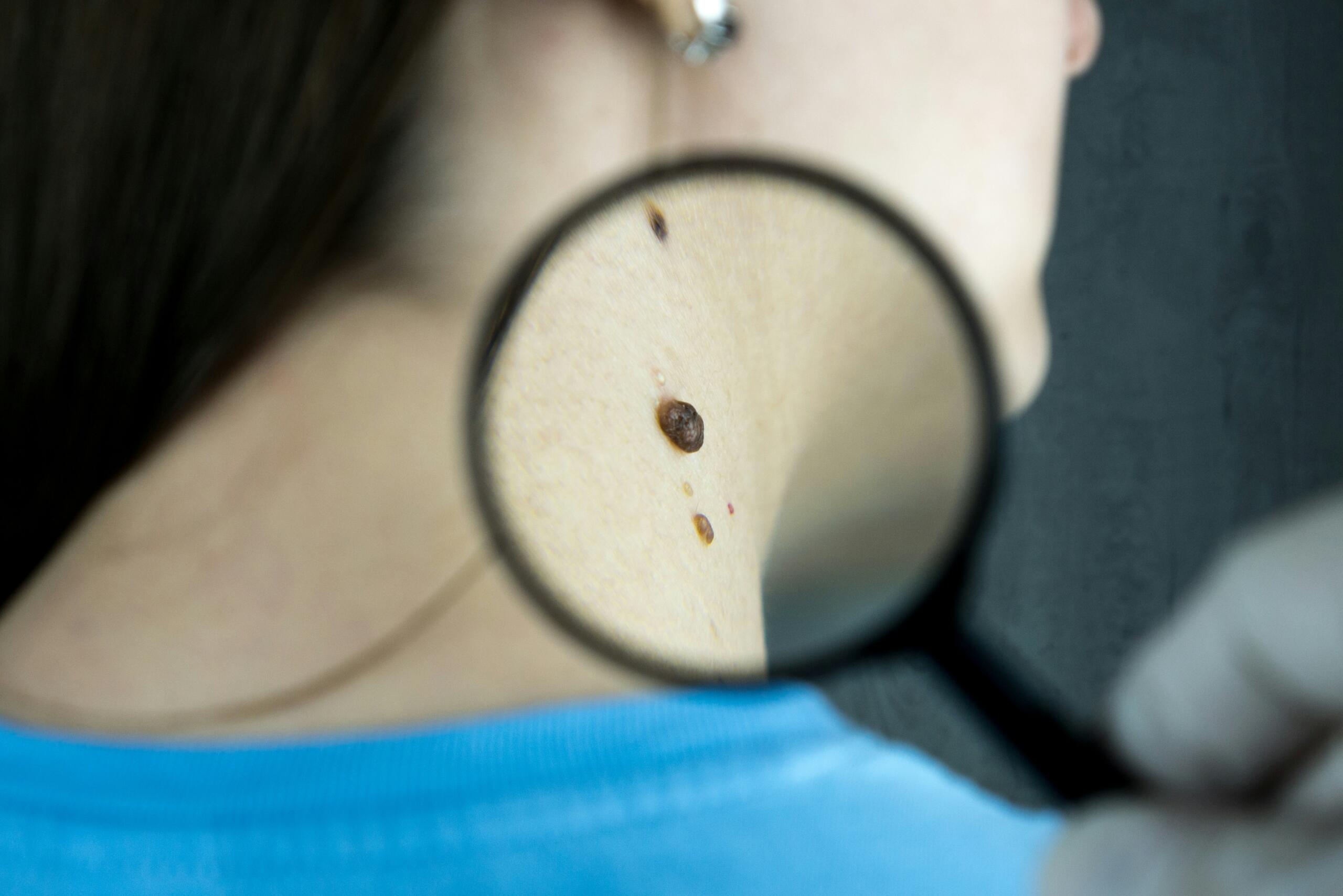 Dermatologist examining a skin mole with a magnifying glass