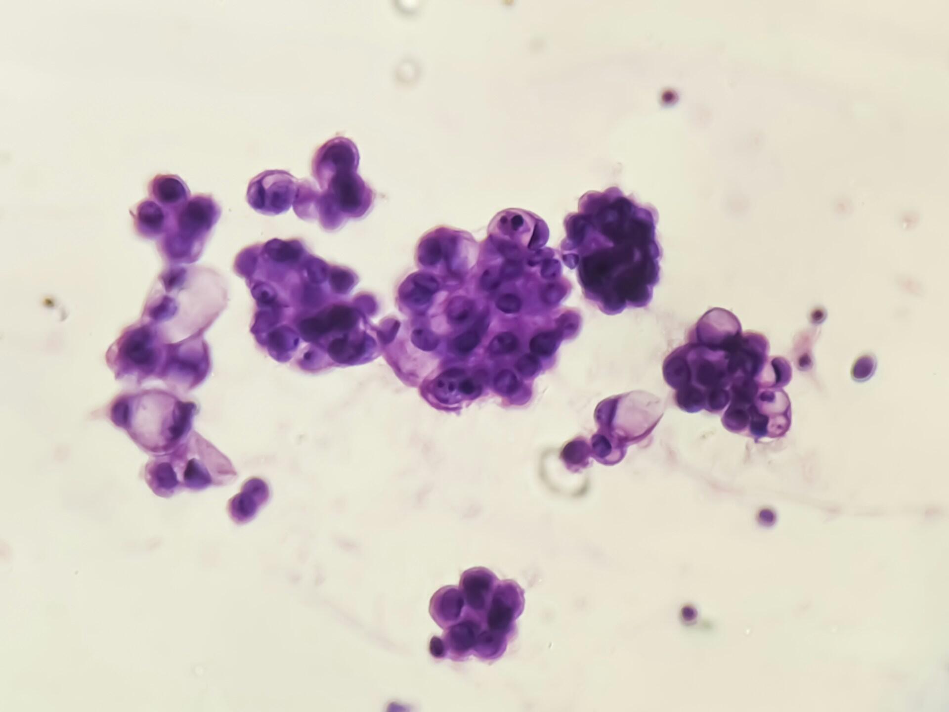 Cytologi celler av adenokarcinom