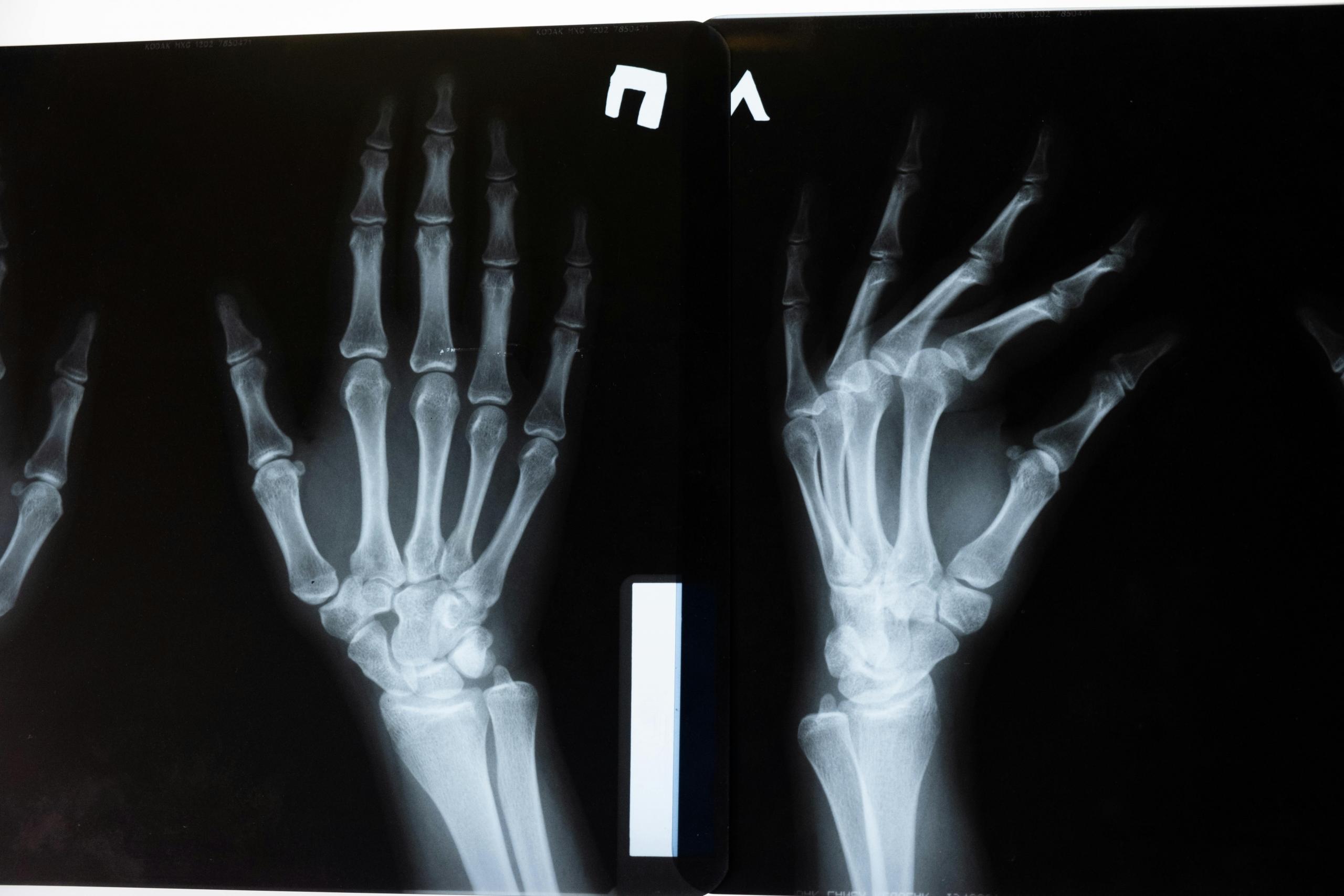 radiografia de dos manos